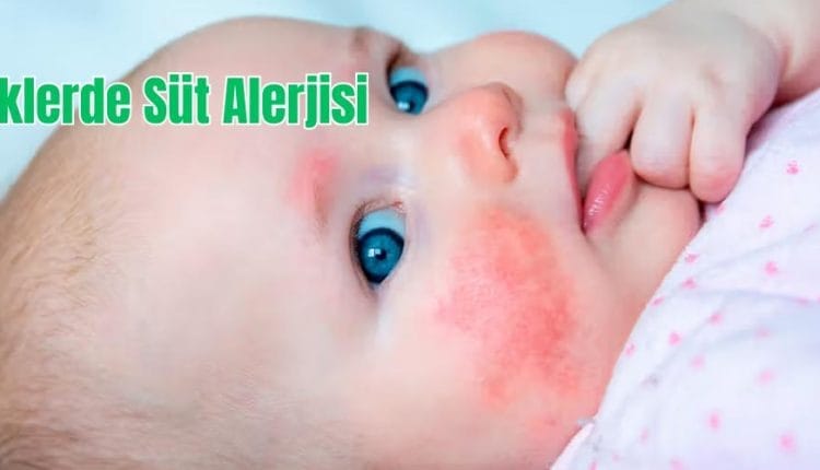 Bebeklerde Süt Alerjisi