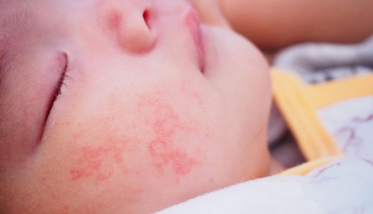 Bebeklerde Alerji Belirtileri: Nedenleri, Tanı Yöntemleri ve Etkili Tedaviler 1 Bebeklerde Alerji Belirtileri