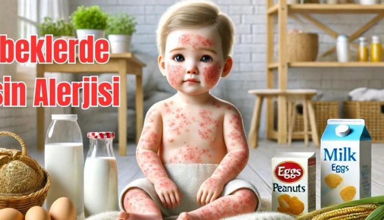 Bebeklerde Besin Alerjisi