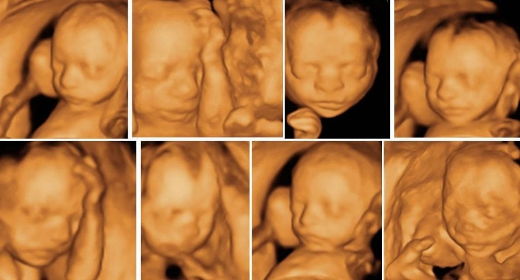 20 haftalık gebelik ultrason görüntüleri