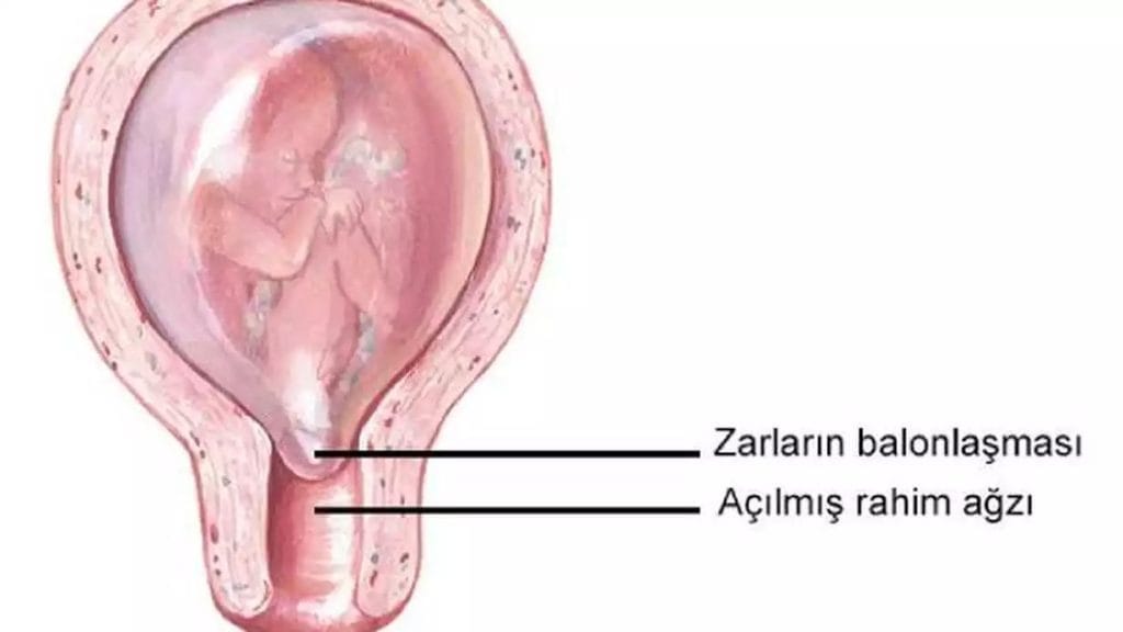 rahim ağzı açılması